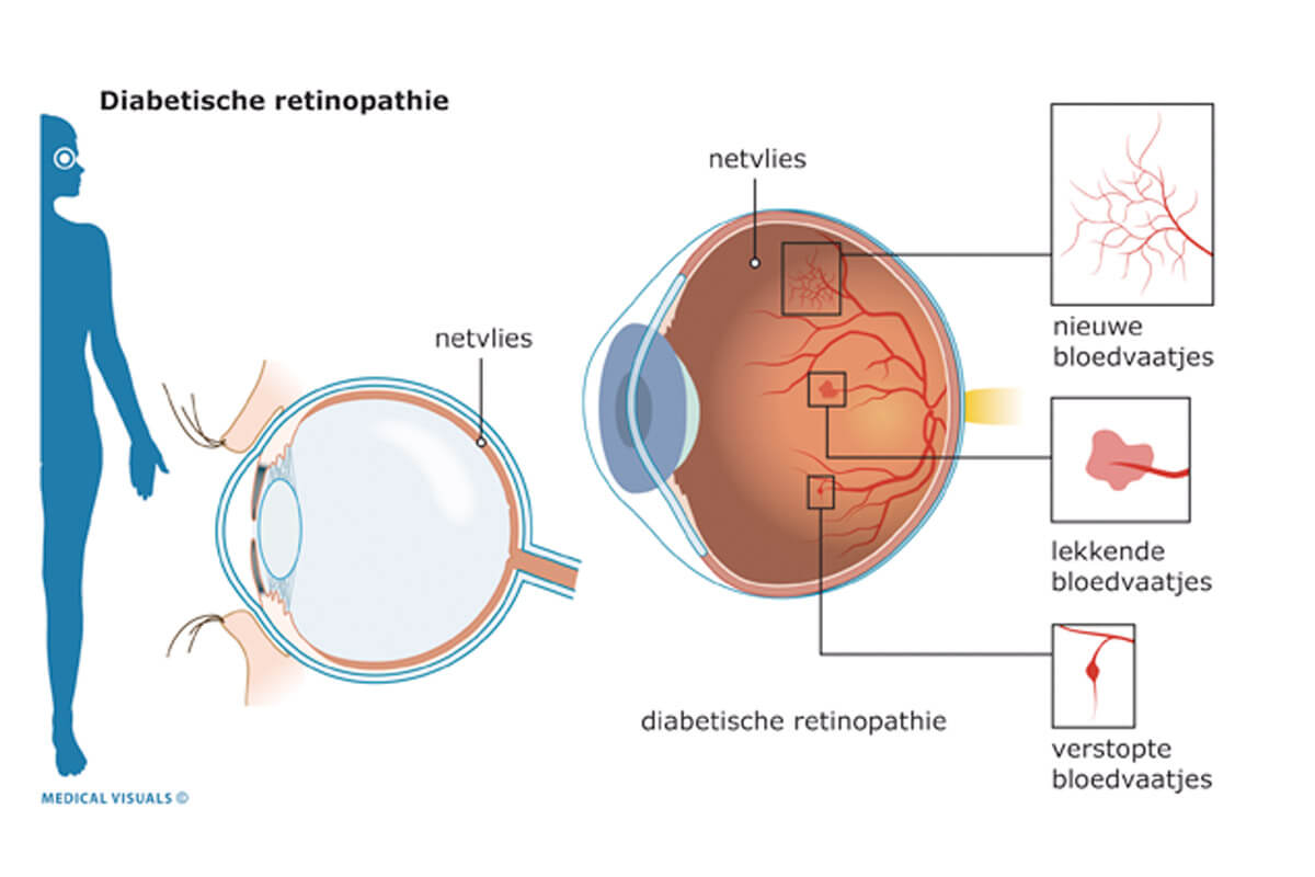 Diabetes – Achtergrond – Hemmer Optiek & Optometrie